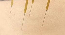 Dry Needling Treatment Hong Kong 