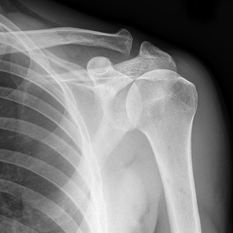 Shoulder Examination X-ray Shoulder Examination X-ray