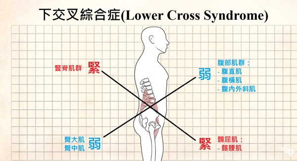 下交叉綜合症