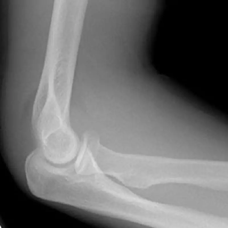 Elbow Joint X-ray 